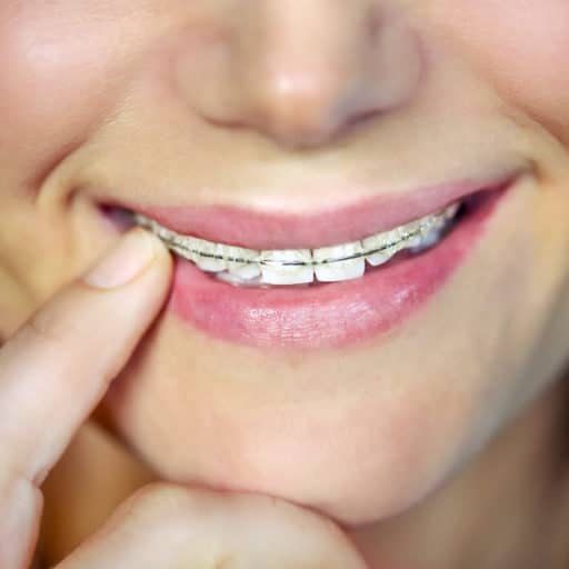 Braces in Meridian, ID Orthodontics at Bridgetower