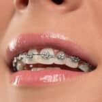 Metal Braces