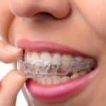 Essix Retainer
