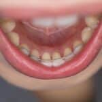 Fixed retainer